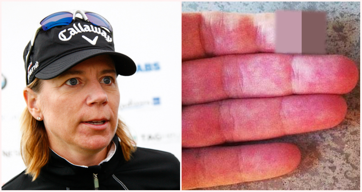 Finger, Annika Sörenstam, Kniv, Golf, Skada